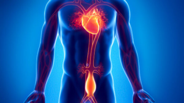 ¿Qué qué es un aneurisma aórtico?