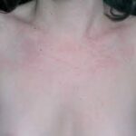 ¿Qué es la enfermedad de Still?