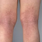Critérios clínicos para el diagnóstico de dermatitis atópica