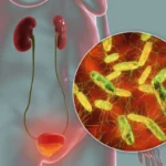 ¿Qué es la bacteriuria?