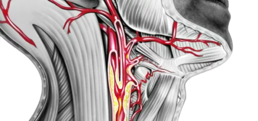 ¿Qué es la arteriopatía carotídea?