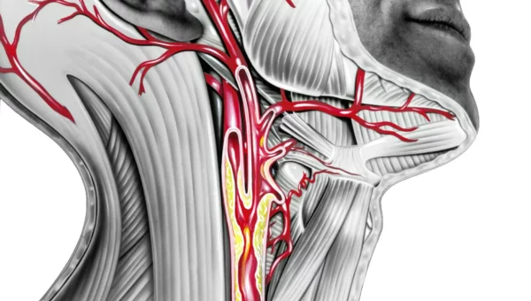 ¿Qué es la arteriopatía carotídea?