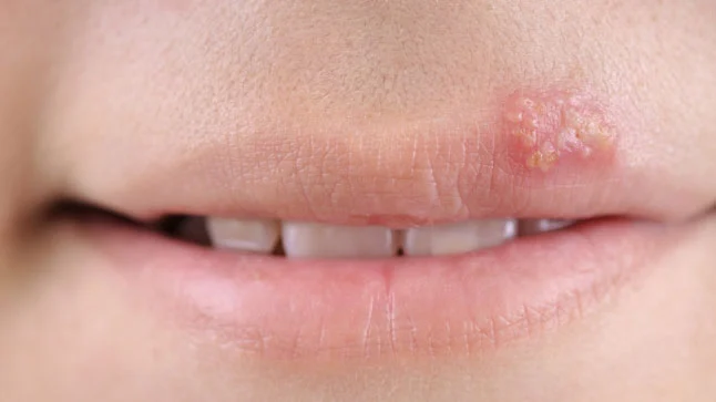 ¿Qué es el herpes labial?