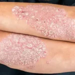 Fármacos que agravan la soriasis