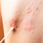 ¿Cuáles son las enfermedades dermatológicas más frecuentes?