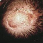 ¿Qué es la aplasia cutis?