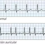 ¿Qué es la fibrilación auricular?