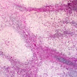 Manifestaciones clínicas de la disfunción hepatocelular