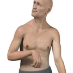 ¿Qué es la enfermedad de Huntington?