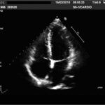 ¿Qué es un ecocardiograma?