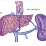 Hipertensión portal en cirrosis hepática