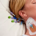 Clasificación de los catéteres venosos centrales de acuerdo al sitio de inserción