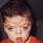 ¿Qué es el síndrome de Apert?