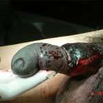Causas de necrosis de pene