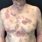 ¿Qué es la micosis fungoide?