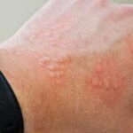 Causas de dermatitis por contacto