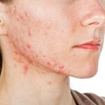 Características del acné vulgar
