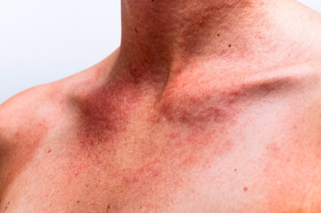 ¿Como se clasifica la fotodermatosis?