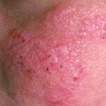 ¿Cuáles son las fotodermatosis primarias?