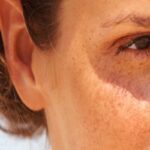 Fotodermatitis causada por químicos