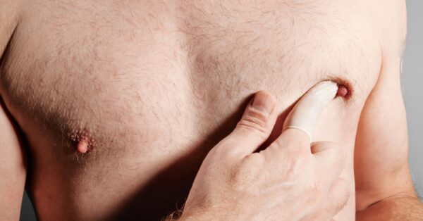 ¿Cuál es el riesgo de cáncer de mama en varones?