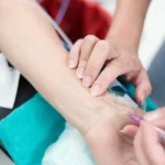 Técnica para la toma de una gasometría