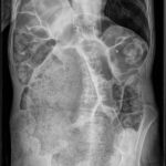 ¿Qué es la coproestasis?