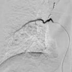 adminostración intraarterial de fármacos