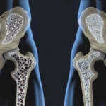 ¿Tiene cura la osteoporosis?
