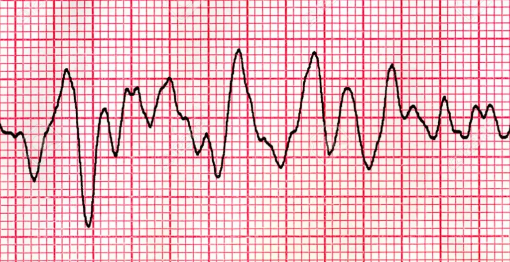 ¿Cómo se define la fibrilación ventricular?