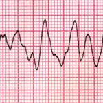 ¿Cómo se define la fibrilación ventricular?