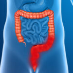 Microorganismo causantes de proctitis infecciosa