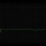 ¿Qué es la asistolia?