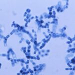 ¿Cuándo debe sospecharse coccidioidomicosis?