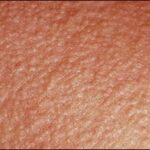 Manifestaciones clínicas de la milaria