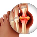 Tratamiento con AINEs del episodio agudo de gota