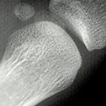 ¿Qué son los huesos sesamoideos?