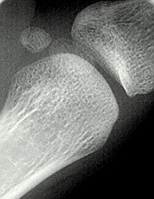 ¿Qué son los huesos sesamoideos?