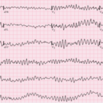 Tratamiento de urgencia de la taquicardia/fibrilación ventricular