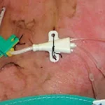 Infección del catéter venoso central