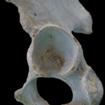 ¿Qué son las caviddes óseas?