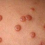 ¿Qué es el molusco contagioso?