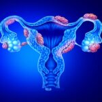 Endometriosis