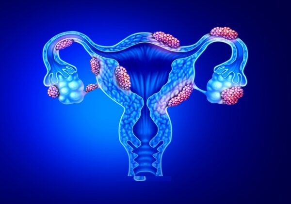 ¿qué Es La Endometriosis Ginecología Homo Medicusemk 0876
