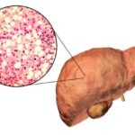 ¿Qué es la hepatopatía grasa no alcohólica?