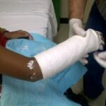 ¿Cuál es la complicación más grave cuando se colocan escayolas?