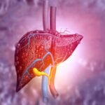 Bilirrubinas en hepatopatía alcohólica
