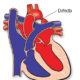 ¿Qué es la coartación de la aorta?