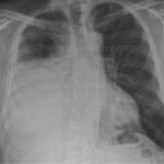 Tipos de derrame pleural