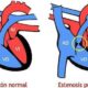 ¿Qué es la estenosis de la válvula pulmonar?